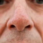Bulbous Tip Rhinoplasty in 2026