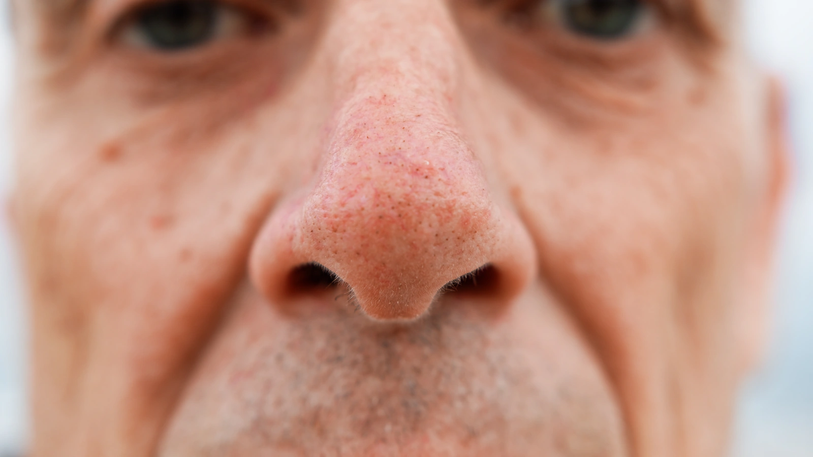 Bulbous Tip Rhinoplasty in 2026